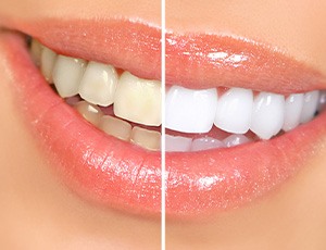 Split image of a smile to show before/after teeth whitening