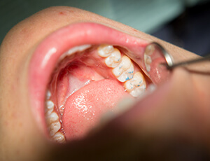 Smile examined after metal-free restoration placement