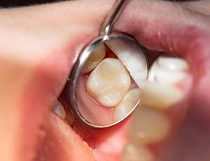 Dental mirror showing a tooth-colored filling