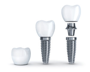 Side view of dental implants