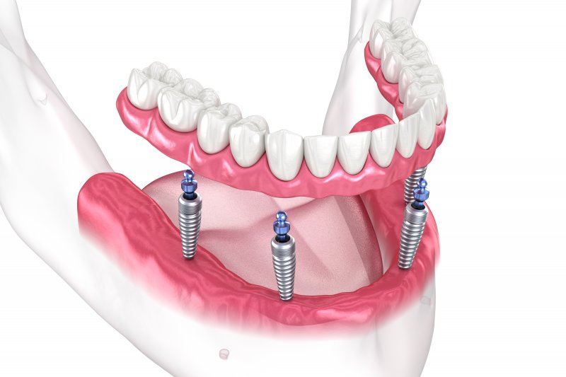 a 3D illustration of All-on-4 dental implants